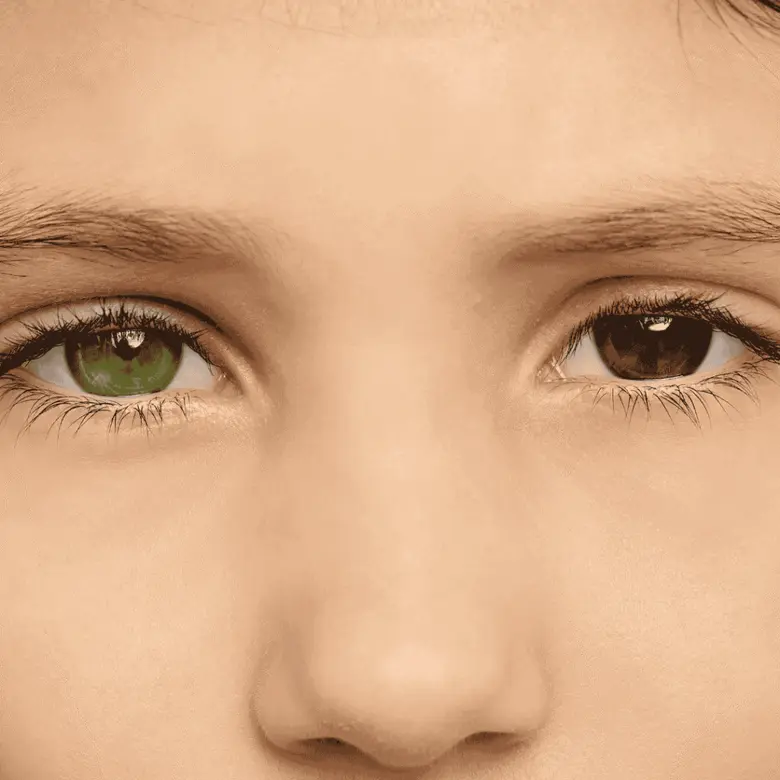 Dvě různé barvy očí - zelená a hnědá - ukázka heterochromie.