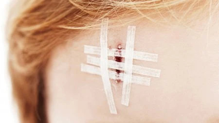 Stitched wound with bandages